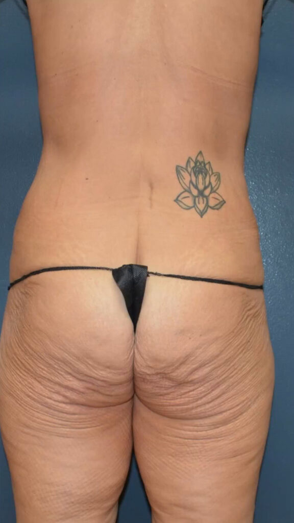 Lower Body Lift