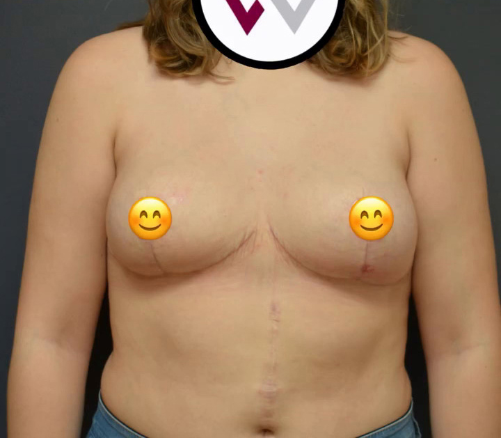 Breast Reduction