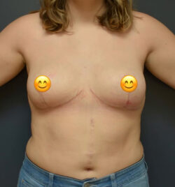Breast Reduction