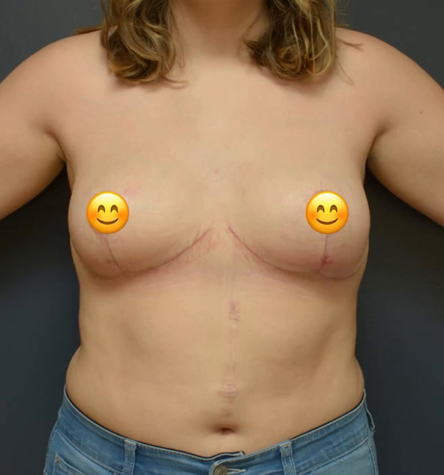 Breast Reduction