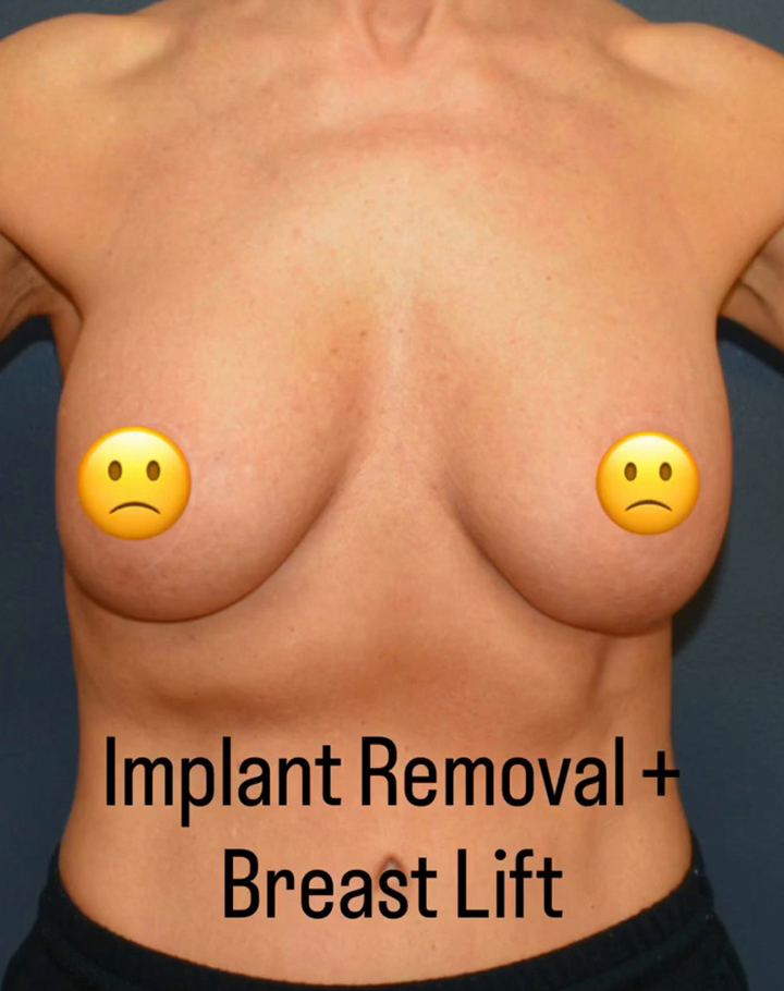 Breast Revision