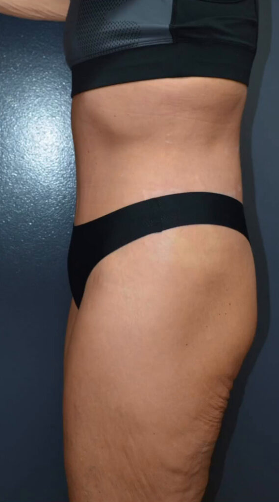 Lower Body Lift