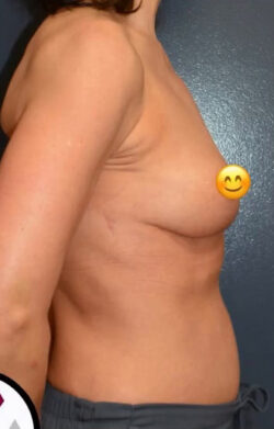 Breast Revision