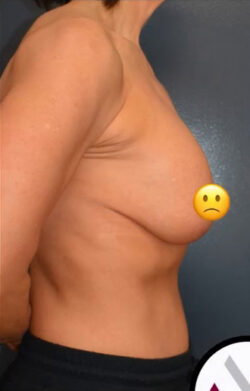 Breast Revision