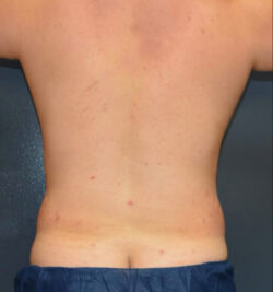Liposuction