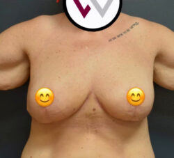Breast Reduction