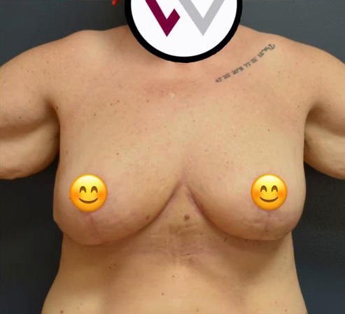 Breast Reduction