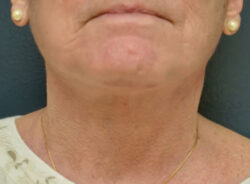 Neck Lift