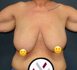 Breast Reduction