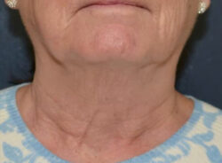 Neck Lift