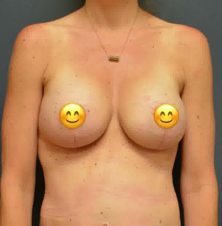 Breast Augmentation