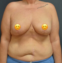 Breast Reduction
