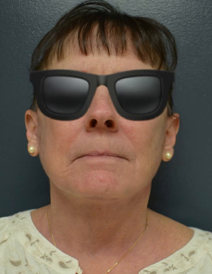 Neck Lift