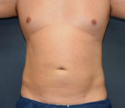 Liposuction