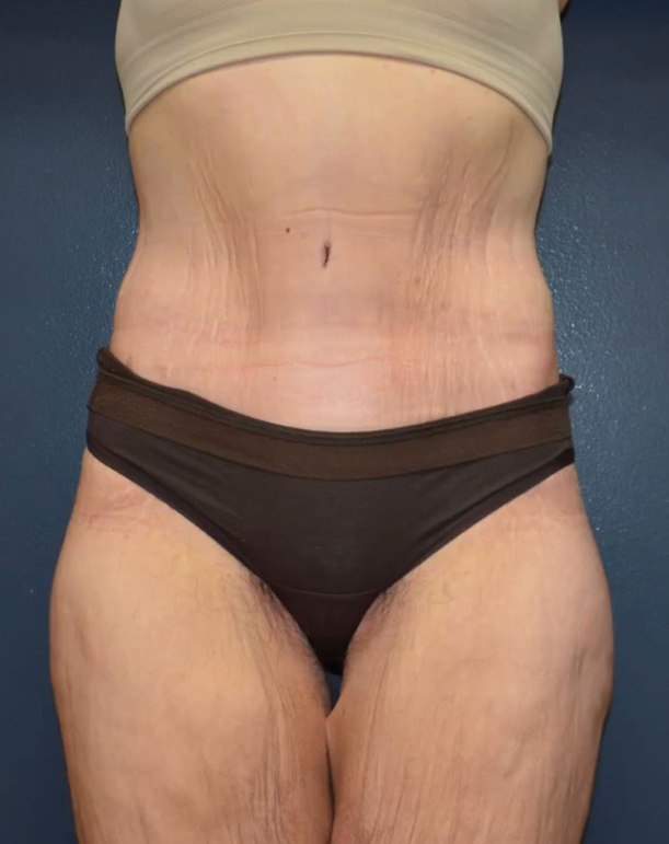 Lower Body Lift