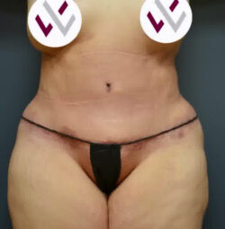 Abdominoplasty