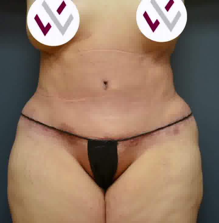 Abdominoplasty