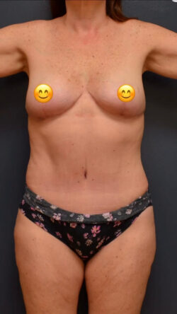 Abdominoplasty