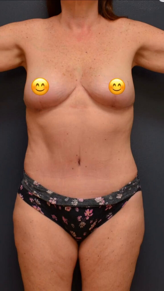 Abdominoplasty