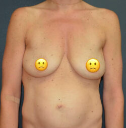 Breast Augmentation