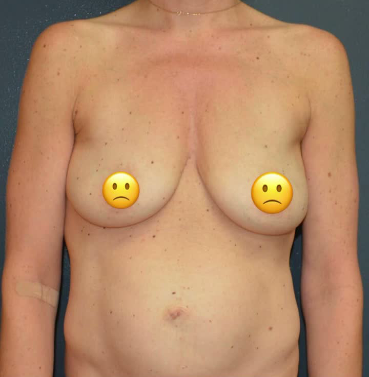 Breast Augmentation