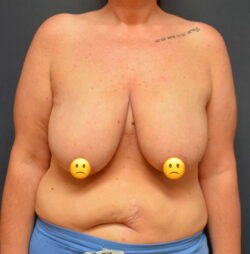 Breast Reduction