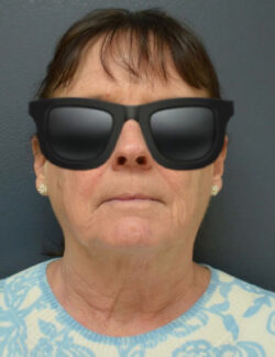 Neck Lift