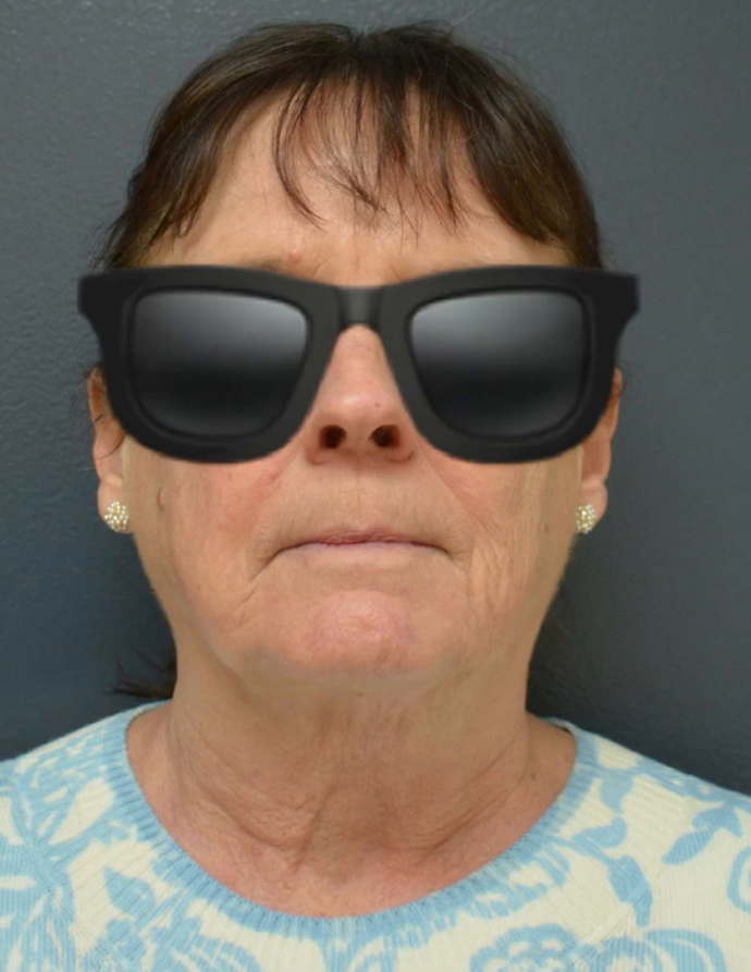 Neck Lift