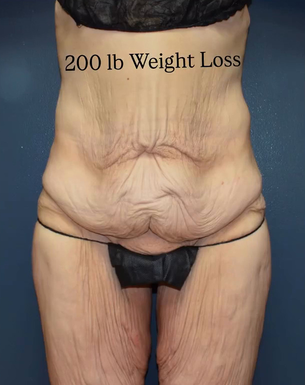 Lower Body Lift