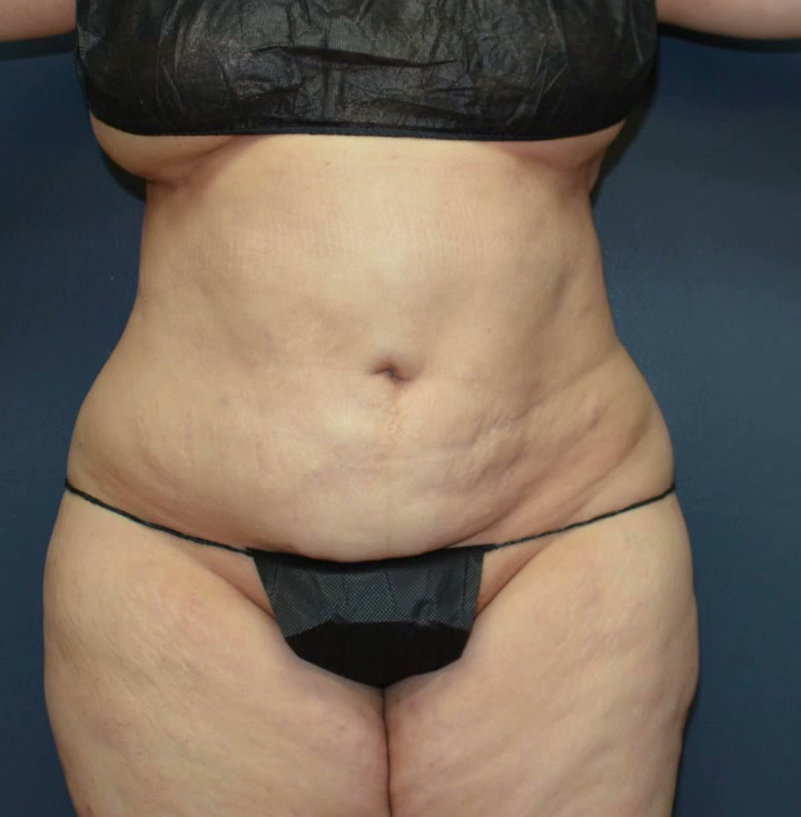 Abdominoplasty