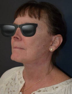 Neck Lift