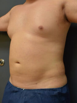 Liposuction