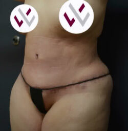 Abdominoplasty
