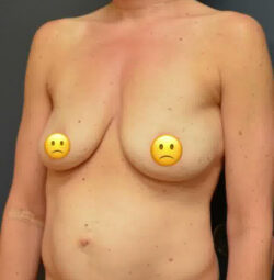 Breast Augmentation