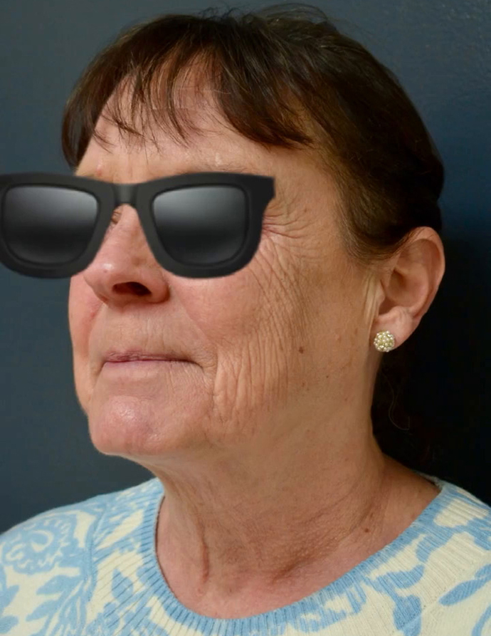 Neck Lift