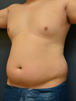 Liposuction