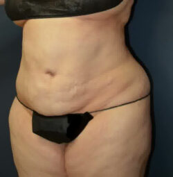 Abdominoplasty