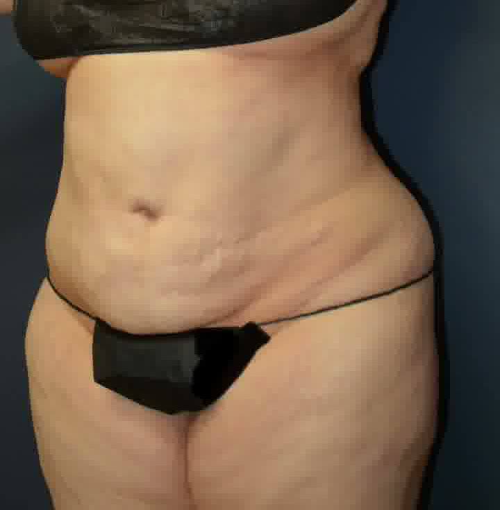 Abdominoplasty