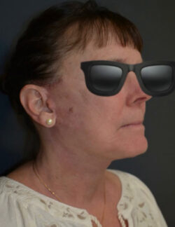 Neck Lift