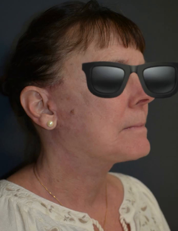 Neck Lift