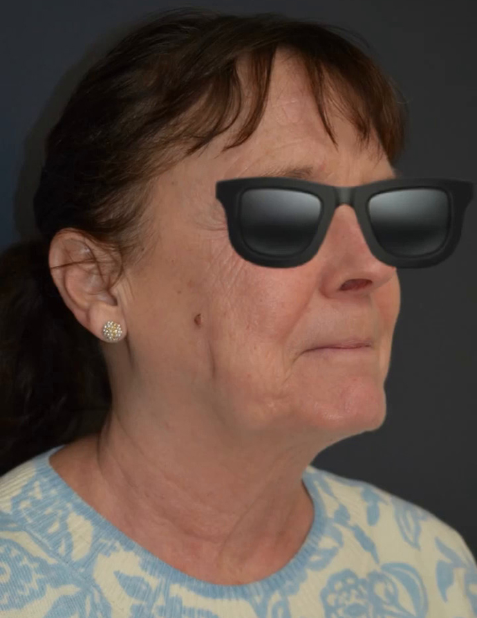 Neck Lift