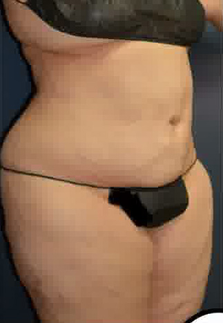 Abdominoplasty