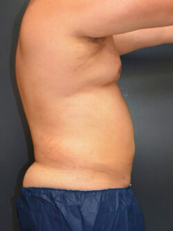 Liposuction