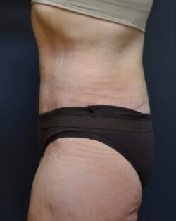 Lower Body Lift