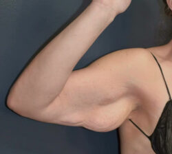 Arm Lift