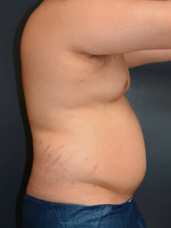 Liposuction
