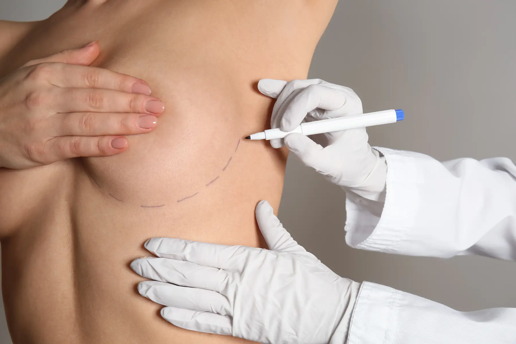 Silicone Breast Implants 2 Surgeon marking patient's breast for cosmetic procedure.