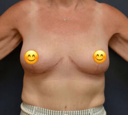 Breast Lift