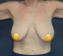 Breast Lift