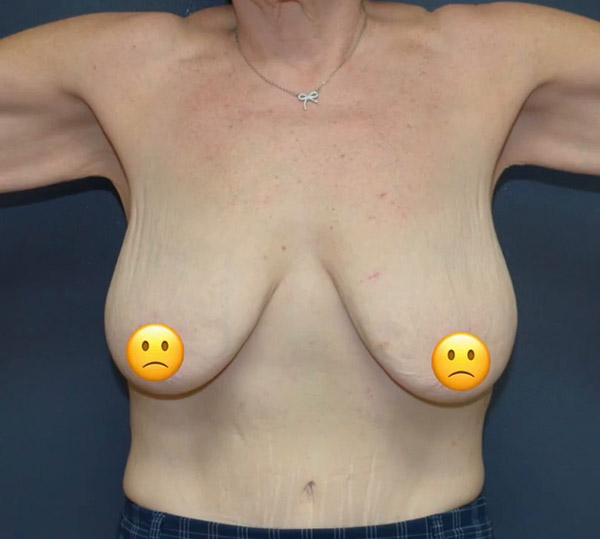Breast Lift
